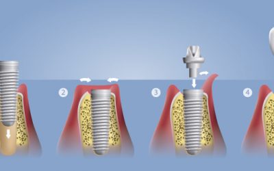 Los implantes Dentales ganan fama entre los vecinos de San Pedro Alcántara